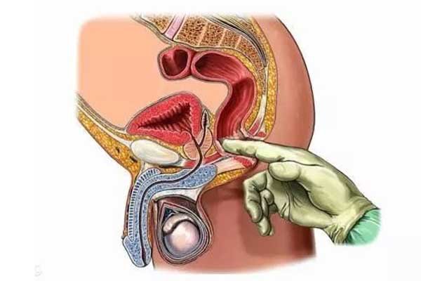 前列腺直肠指检怎么做