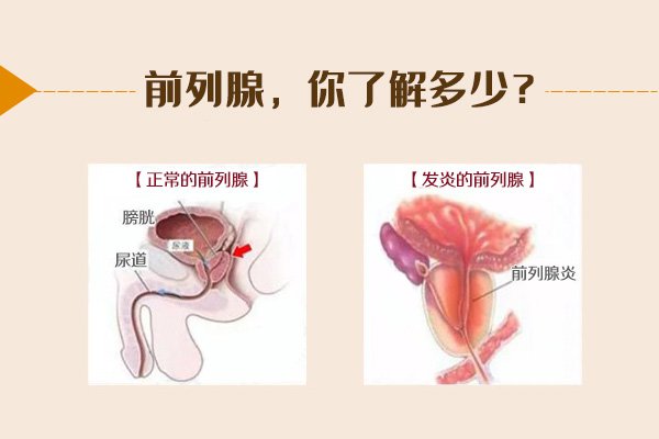 前列腺囊肿是怎么回事